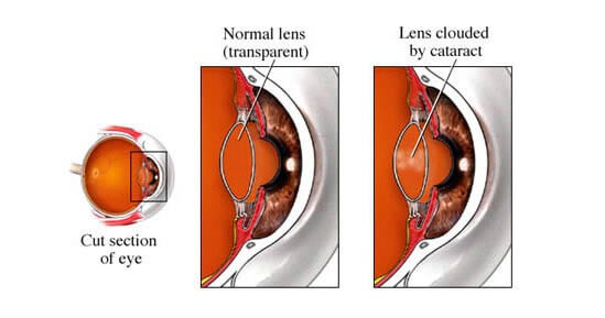 Cataracts causes