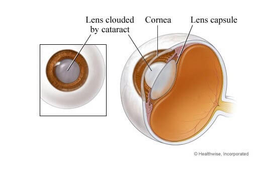 Cataracts what is it