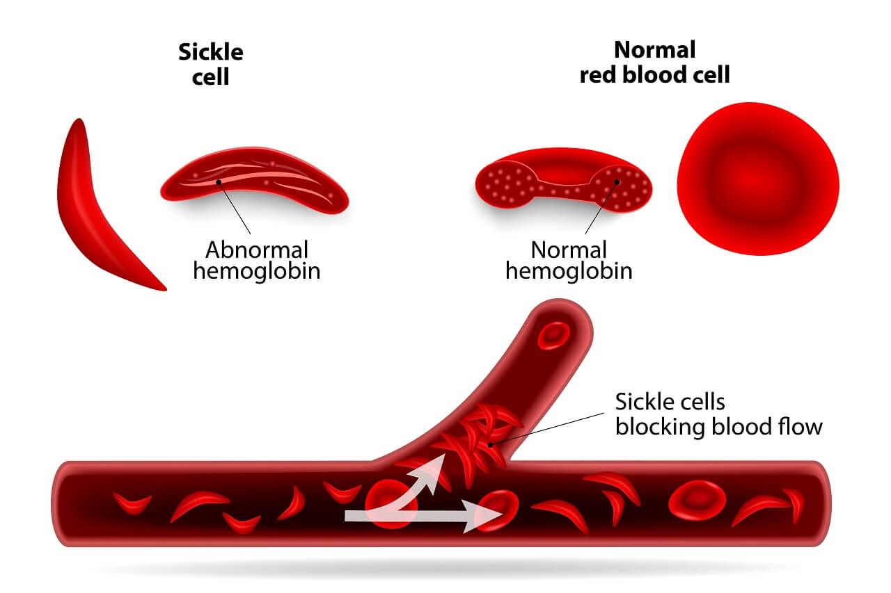 Sickle cell vs normal blood cell