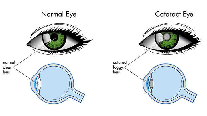 cataract eye crossection copy