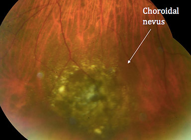 Choroidal nevus