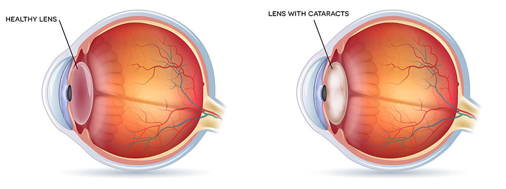 cataract chart