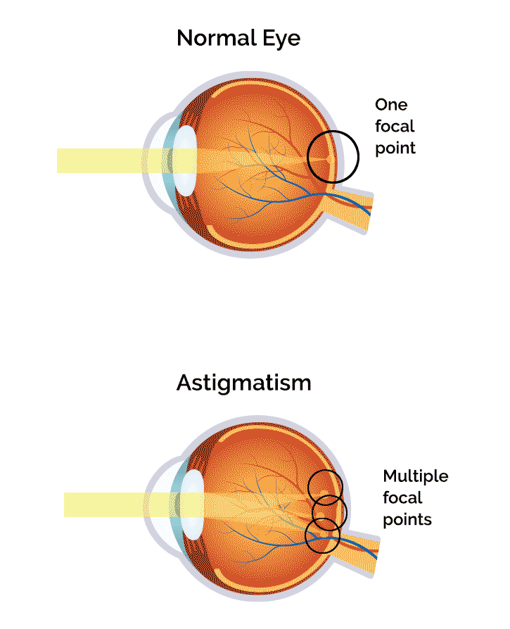 normal eye and eye with astigmatism