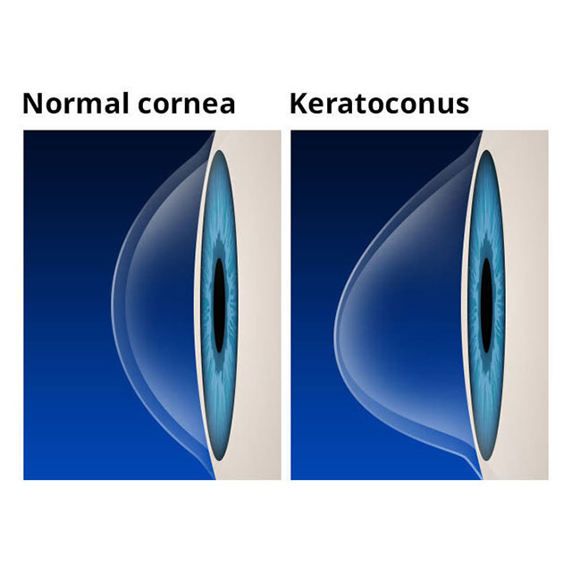 Diagram explaining Keratoconus