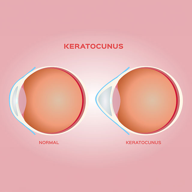 Diagram explaining Keratoconus