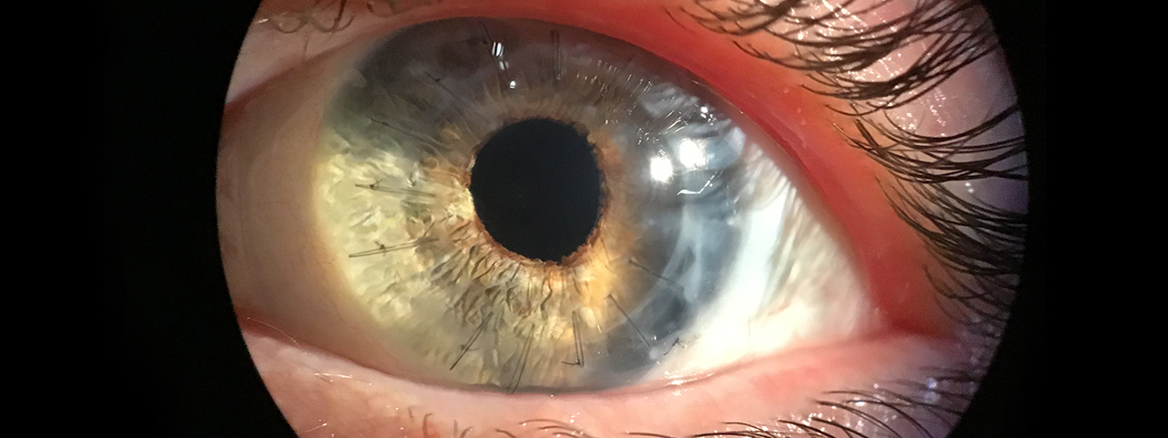 Close-up of eye being scanned for eye disease in Niles