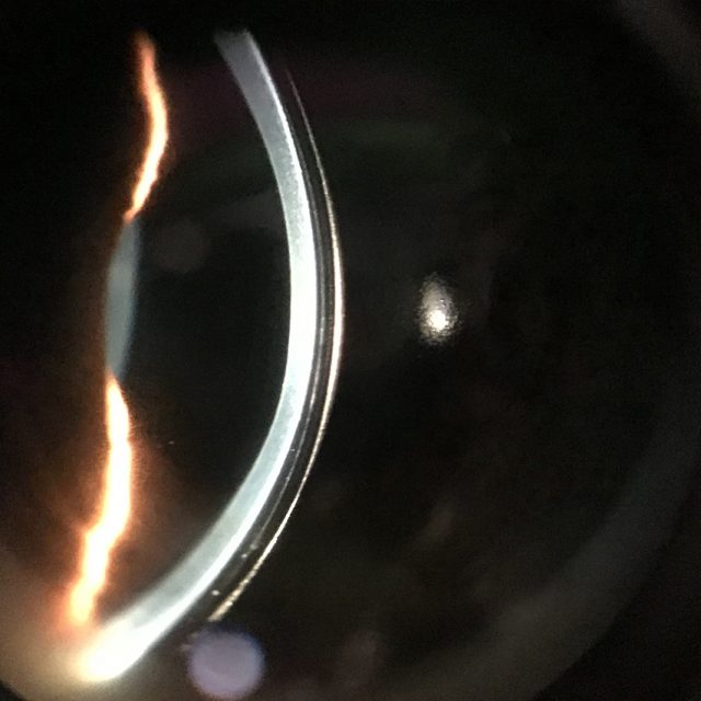 Cornea With Scleral Lens