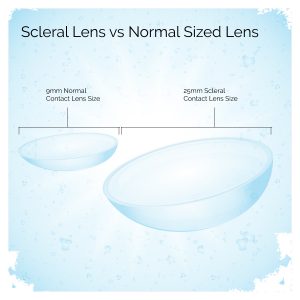 Sclereal Lens size