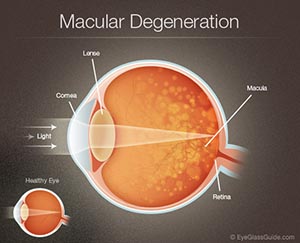 macular degeneration diagram