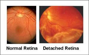 detached retina