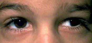 Eye doctor, kids eye Strabismus without Amblyopia in Old Bridge, NJ