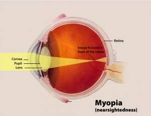 diagram explaining myopia