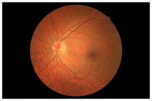 glaucoma_detection_