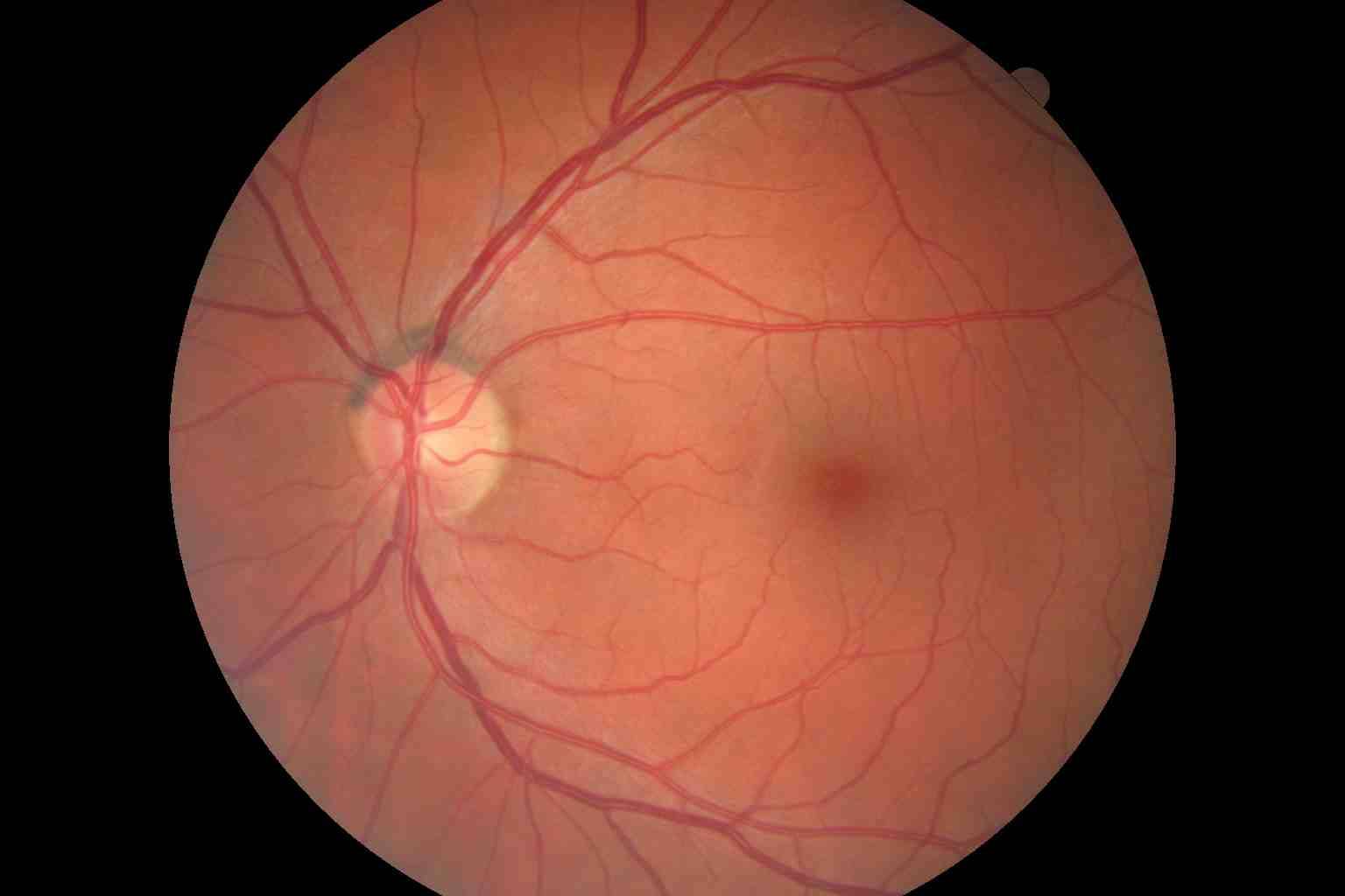 Examples of retinal photos from our fayetteville office