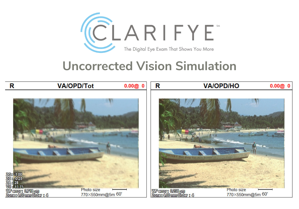 Clarifye Uncorrected Vision Simulation used by The Eye Center