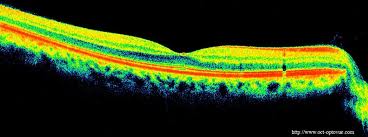 Optical Coherence Tomography eye exam burlington