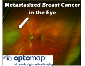 Metastasized Breast Cancer in the Eye