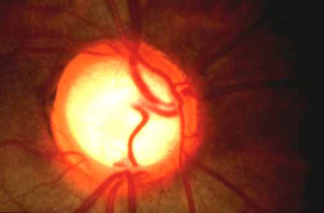 Optic Nerve with Glaucoma