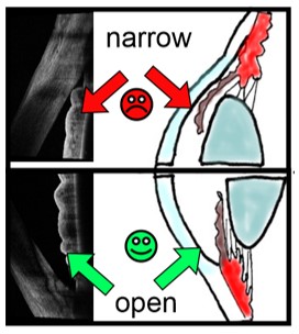 narrow open
