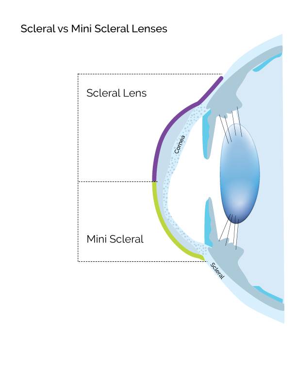 Sclereal MiniSclereal Lenses.jpg