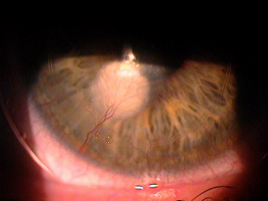Corneal_Neovascularization grand prairie tx eye doctor