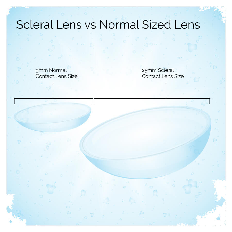 Sclereal-Lens-size