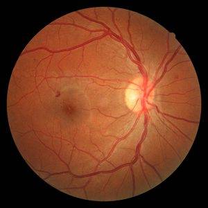 Diabetic-retinopathy3