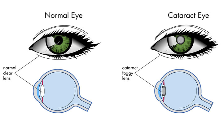 cataract eye cross section
