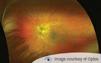 retina eye exam Bellevue, WA