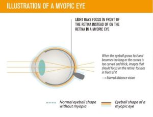 miyosmart lenses 3
