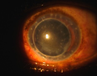 Scleral Lens on an actual eye - Baltimore, Maryland