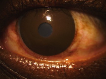 Black outline of Scleral Lens on an actual eye - Baltimore, Maryland