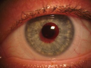 Example of a specialty contact lens that treats color blindness