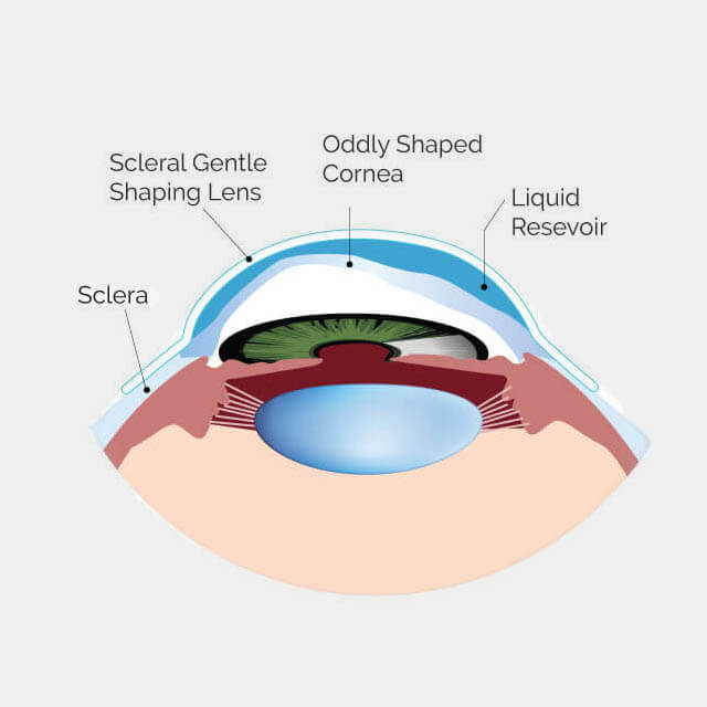 Plaats Hoopvol Seraph What Are Scleral Contact Lenses? | Baltimore, MD