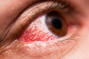 red eye - optometrist Indiana