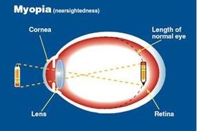 Myopia diagram1