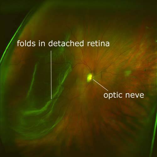 Detached Retina Scan with Daytona Optomap