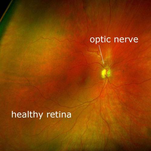 Healthy Retina Scan with Daytona Optomap