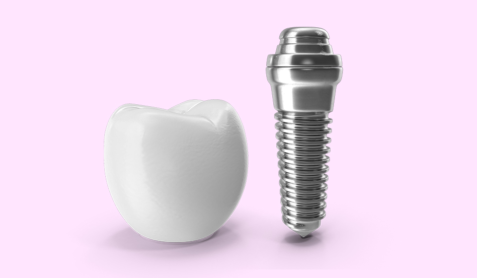 Dental Implants in Irving