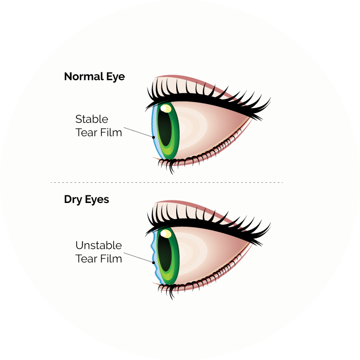 dry eye syndrome diagram