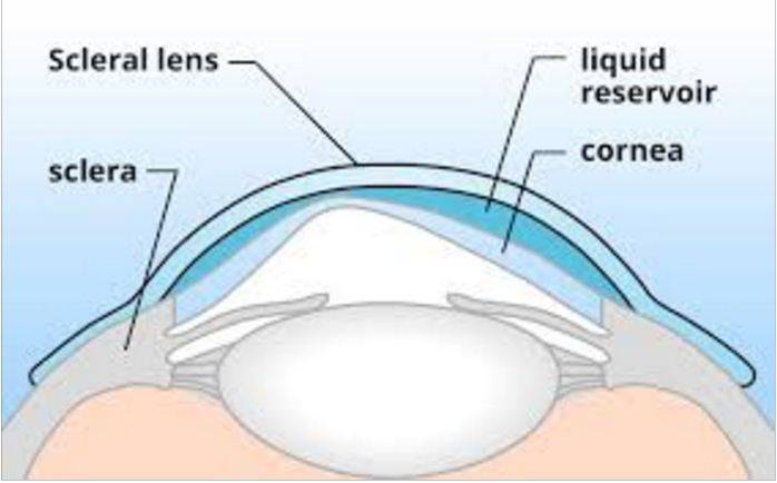 scleral contact lenses and eye exam in washington dc