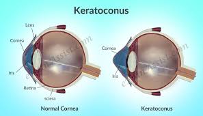 keratoconus 2