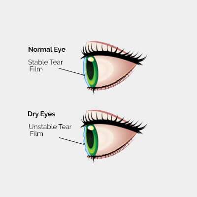 dry eye diagram 2a.jpg