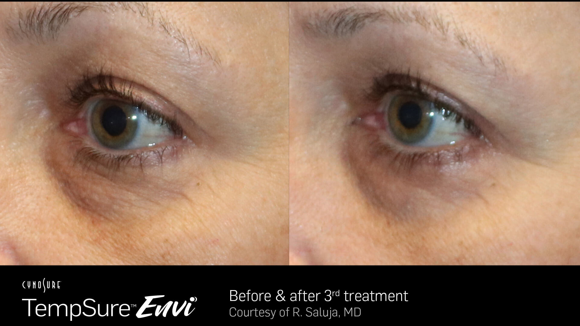 TempSure Envi Before and After Image 4