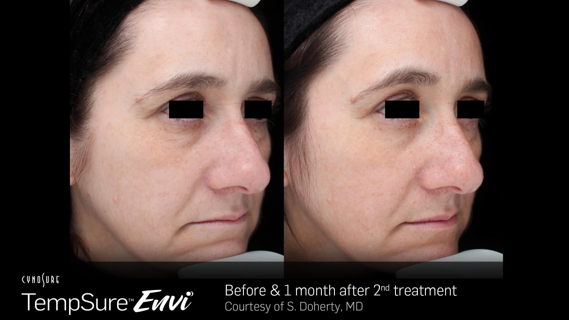 TempSure Envi Before and After Image