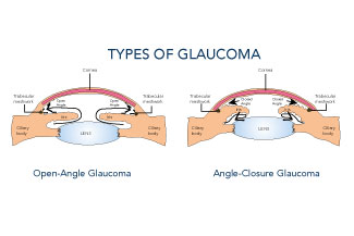 glaucoma thumbnail.jpg
