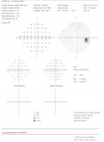 visual field scan results - eye exam Athens GA 