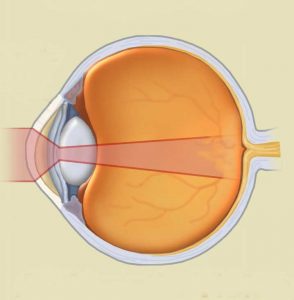 irregular corneas and scleral lenses in Rye, NY