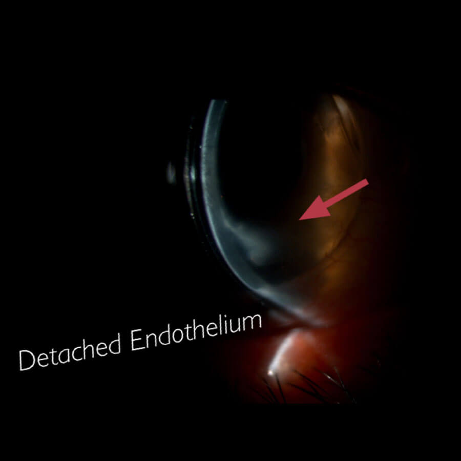 Detached Endothelium