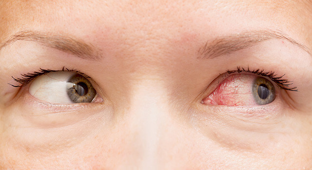 woman with pink eye